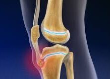 Osgood-Schlatter and Sever Disease – Evidence based advice.