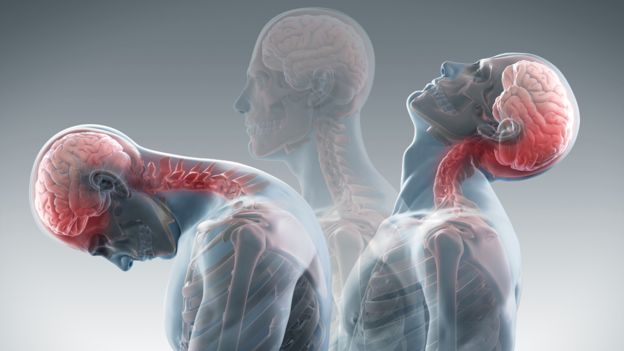 Whiplash – the role of Physiotherapy